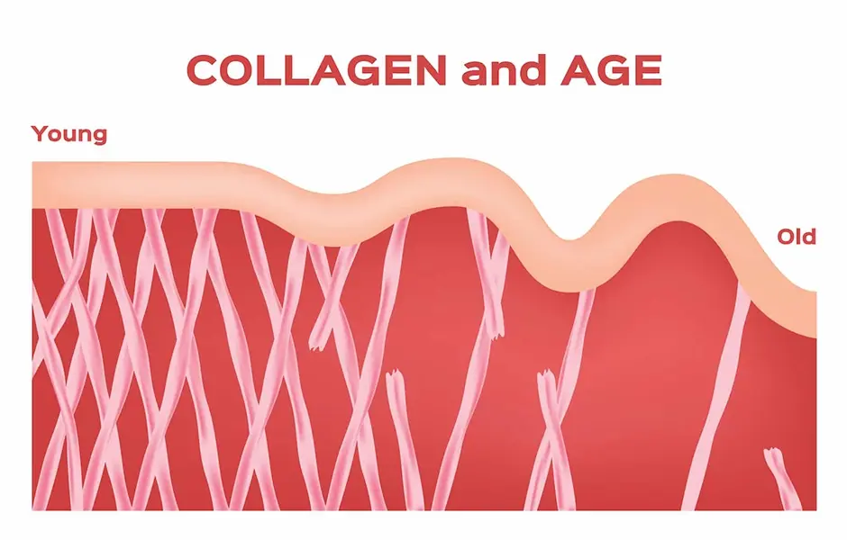 Collagen Production through Poly L Lactic Acid