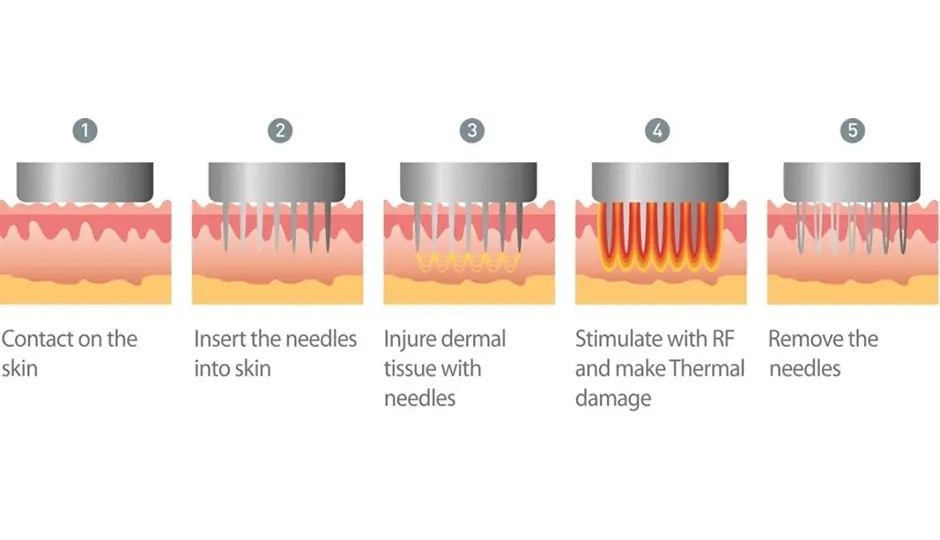Radiofrequency Microneedling: The Science Behind Morpheus8